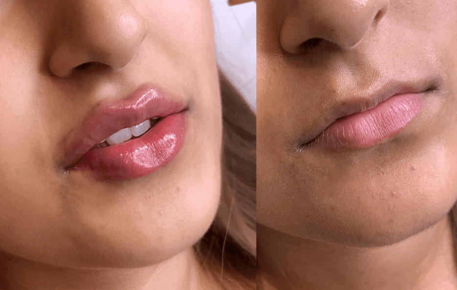 Juvederm Lip Enhancements At Soluna London