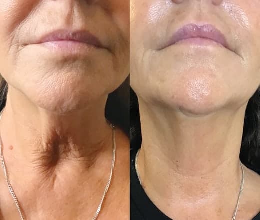 Do you want to lift and tighten sagging skin or restore natural contours? This cutting-edge treatment works wonders without surgery or downtime. Say goodbye to fine lines and hello to a smoother, firmer, and more radiant you effortlessly! Treat yourself to a revitalising transformation today!