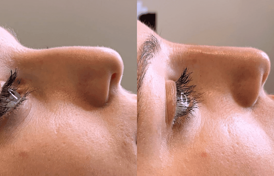 Rhinoplasty