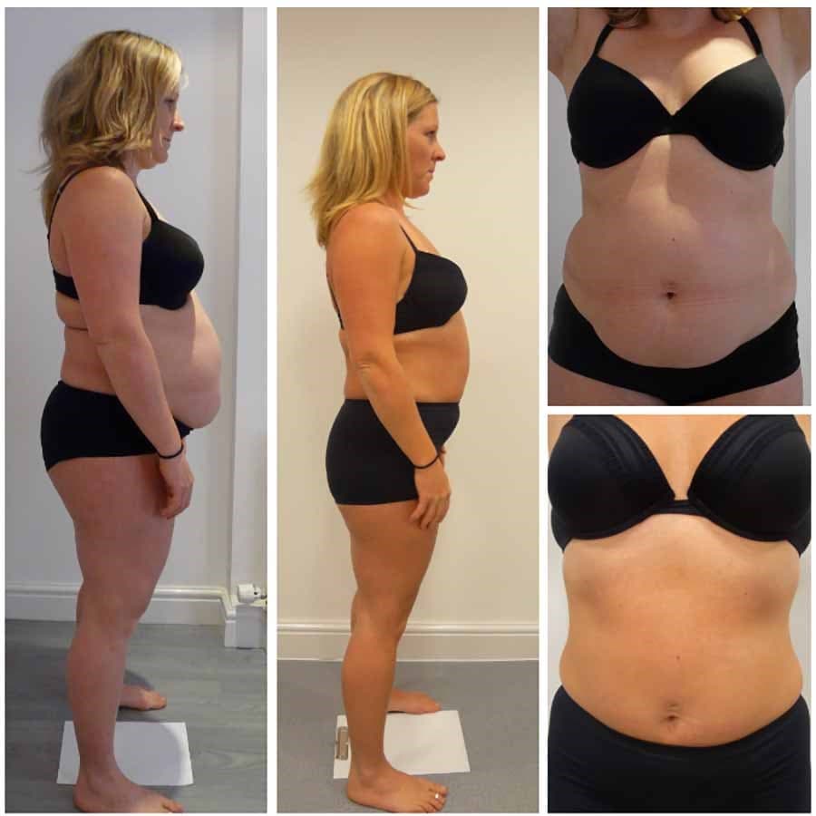 3D 5 Point Lift Using a Unique Combination of the latest non- surgical technologies Cryolipolysis, Body HIFU and shockwave, we can specifically sculpt and shape your most tricky stubborn areas for an overall solution. Call 0333 016 3500.