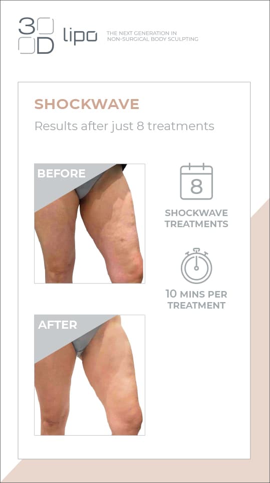 3D Bespoke Cellulite Removal A prescriptive treatment tailored to meet your needs using a combination of 3D Shockwave and 3D radiofrequency is used to reduce cellulite. Call 0333 016 3500.