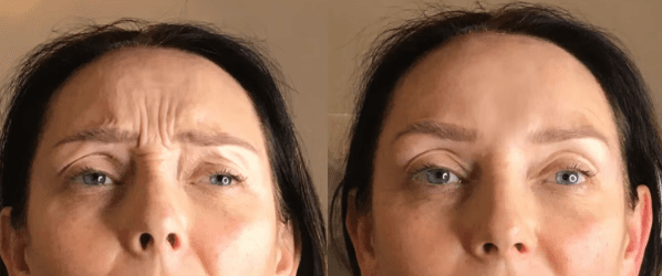 Anti-wrinkle Review