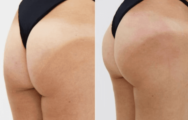 Nonsurgical Bum Lift The non surgical bum lift is one of the most innovative treatments available in the UK. Helping women of all ages achieve the perfect bum! Call 0333 016 3500.