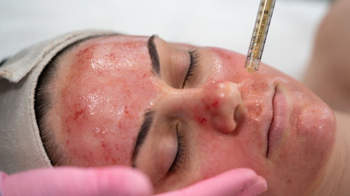 Dracula Skin Therapy Have a Dracula facial in Bromley with us. It is a replenishing healing treatment using your own natural resources. For crows feet, acne scars and more