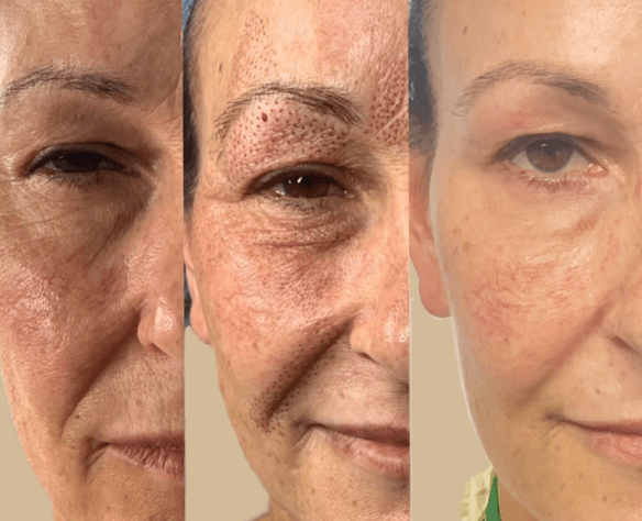 Plasma Fibroblast Skin Tightening  Our Fibroblast Skin Tightening Treatment is for eyelid lifting and tightening, wrinkle reduction, neck tightening, upper lip wrinkles and scars. 