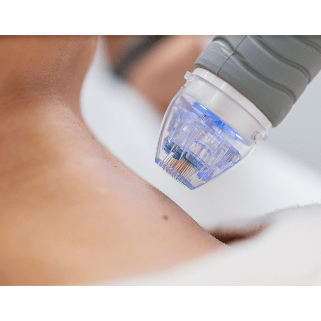 BODY MICRONEEDLING Using a medical-grade Dermapen, we provide precise, safe, and effective skin rejuvenation, stimulating collagen for smoother, younger-looking skin. Call 0333 016 3500.