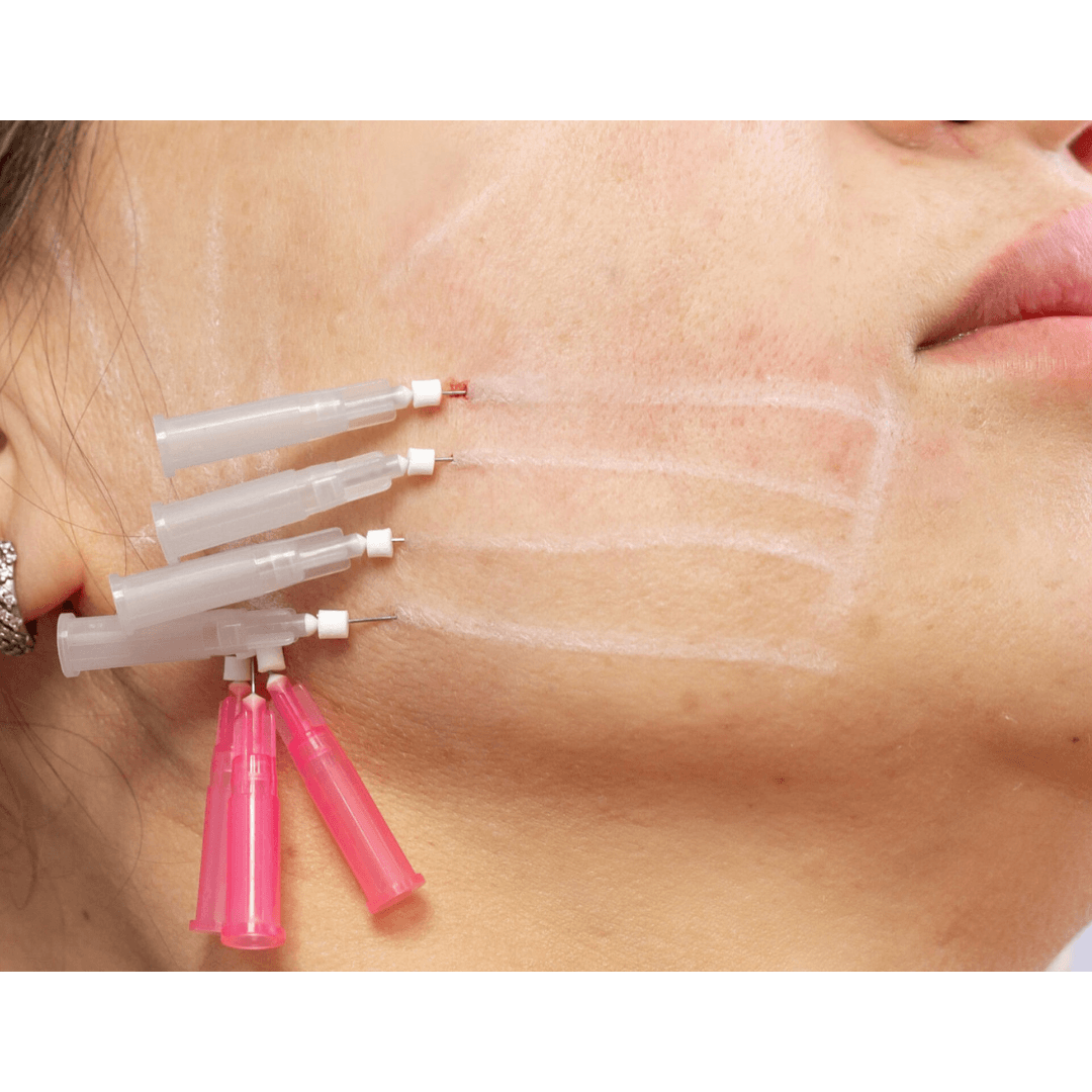 PDO THREADS Discover the magic of a PDO thread lift, a non-invasive procedure designed to lift and rejuvenate your skin for a refreshed, youthful appearance. Call 0333 016 3500.