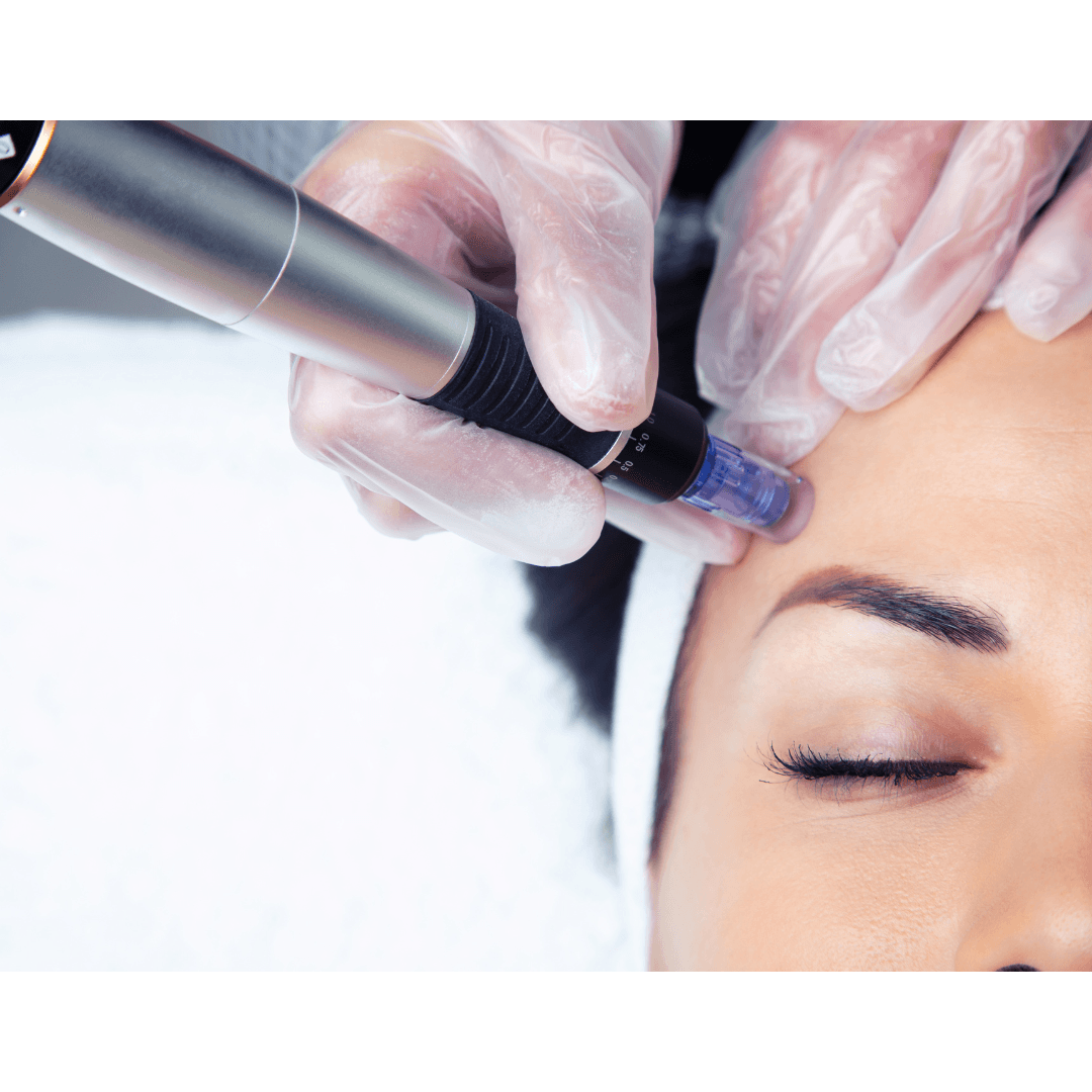 FACIAL MICRONEEDLING